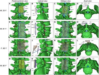 Computer-modified paramedian approach technique reduces failures and alleviates pain in lumbar puncture: a prospective comparative study